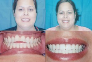 Cosmetic Dental Bonding Lincoln Park, Lakeview, Chicago, IL